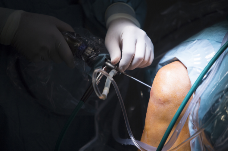 Arthroscopy