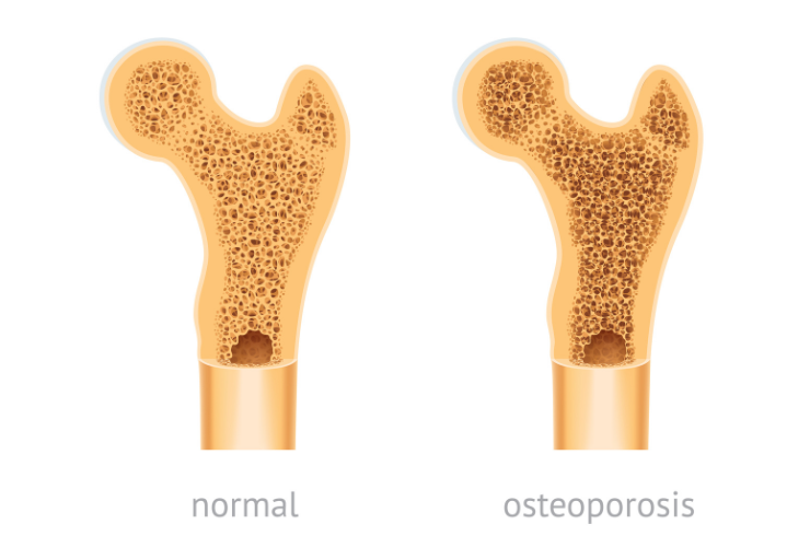 Osteoporosis Treatment