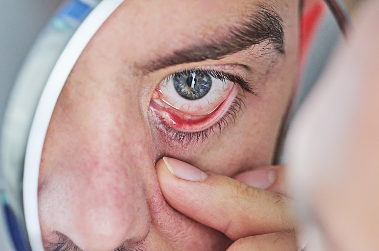 Dry Eye & Autoimmune Diseases