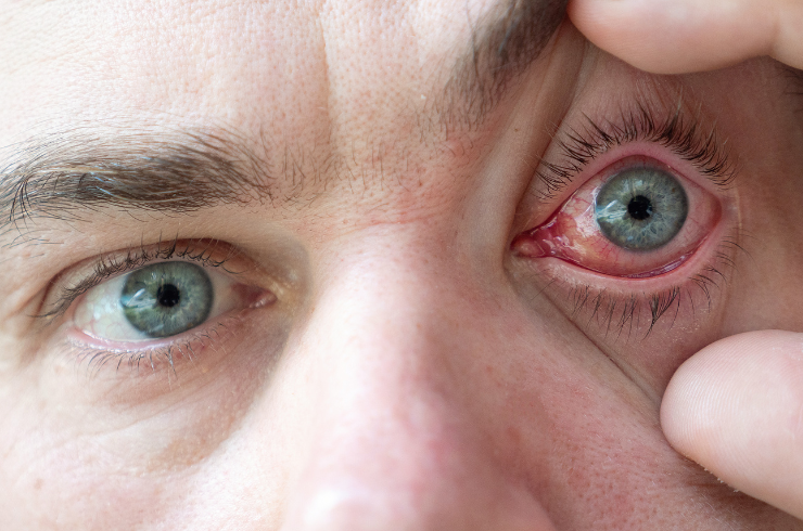 Conjunctivitis Treatment